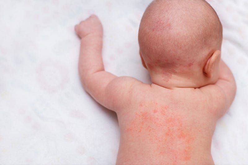 Food Allergy vs. Food Intolerance in Infants
